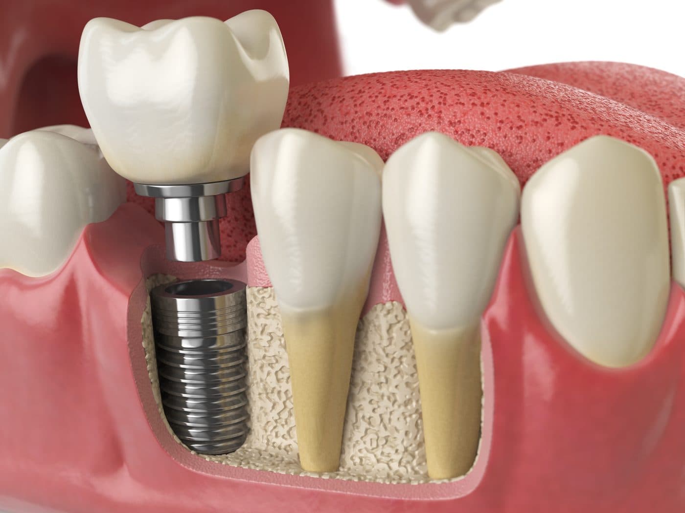 Corte transversal de un implante dental: corona, pilar y tornillo integrado al hueso